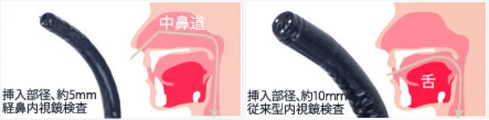 径鼻内視鏡検査